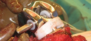 Illustration 54 for Hinged Total Knee: The Salvage Solution for Challenging Cases