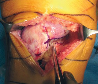 Illustration 6 for Minimally Invasive Subvastus: The Best Path to Quicker TKA Recovery