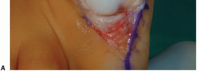 Illustration 14 for Mastering Extensive Plantar Release for Hallux Rigidus