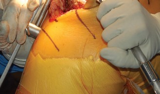 Illustration 20 for Mastering Gap Balancing in Revision TKA: Avoid Common Pitfalls