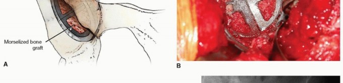 Illustration 7 for Uncemented Acetabular Component: Augments & Cup-Cages for Bone Loss