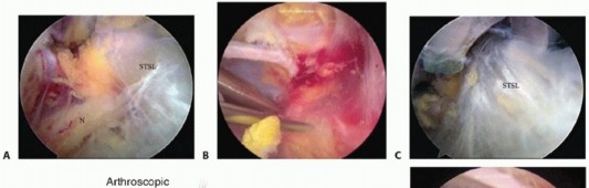 Illustration 9 for Decompressing the Transverse Scapular Ligament for Shoulder Pain Relief
