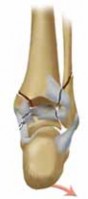 Illustration 7 for Optimal Fixation of the Ankle: Open Reduction & Internal Fixation