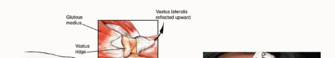 Illustration 6 for Mastering Femoral Metastases: Optimal Function for Femoris & Vastus