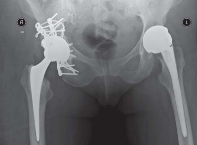 Illustration 44 for Management of Periprosthetic Fractures: An Expert Surgical Guide