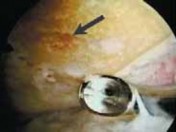 Illustration 19 for Microfracture Chondroplasty: How Tiny Holes Are Made to Fix Cartilage