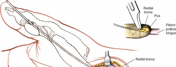 Illustration 242 for Essential Surgical Approaches: Uncover Every Aspect of the Wrist