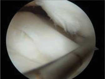 Illustration 11 for Pediatric OCD: When to Consider Drilling for the Femoral