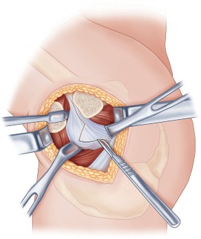 Illustration 28 for Figure Hip Resurfacing: Who Benefits and Who Should Avoid It?