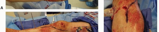 Illustration 37 for Tibia External Fixation: See How Pins Are Placed for Healing