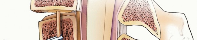 Illustration 23 for Stop Numbness & Instability: Corpectomy and Fusion Guide