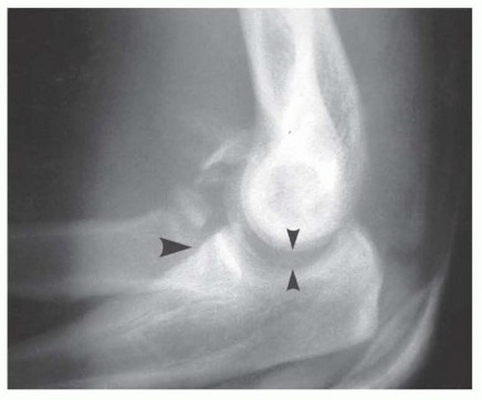 Illustration 11 for Restore Stability & Motion: Fixation of Fracture-Dislocations