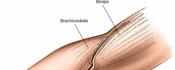Illustration 52 for Mastering Elbow Approaches: Applied Surgical Anatomy for Precision