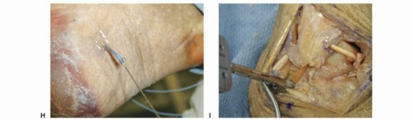 Illustration 22 for Lateral Ankle Repair: Maximize Stability with Interference Screw Fixation