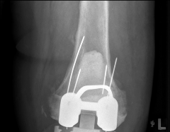Illustration 35 for PROSTALAC Articulating Spacer: Treat Infected Knees, Regain Mobility