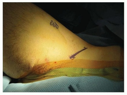 Illustration 9 for Septic Hip in Children: Mastering Anterior Drainage for Optimal Recovery