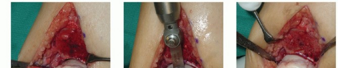 Illustration 10 for Unlock Healing: Medial Malleolar Osteotomy for Talus OLT Allografts