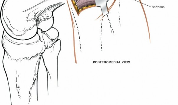 Illustration 80 for Mastering Knee Approaches: Spotlight on Superficial Medial Ligament