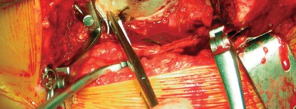 Illustration 28 for Cemented Component Longevity: The Critical Margin of the Acetabulum