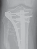 Illustration 64 for Optimal Nailing of the Tibia: Techniques for Challenging Fractures
