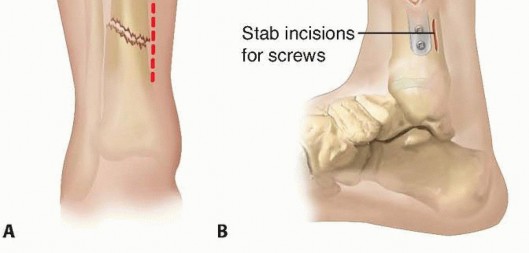 Illustration 9 for Optimal Treatment for Pediatric Tibial Fractures: Key Insights