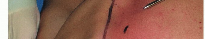 Illustration 21 for Is Your Dorsal Scapular Nerve Causing Snapping Scapula Pain?