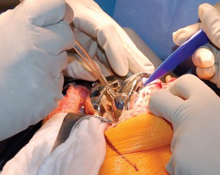 Illustration 60 for Mastering Gap Balancing in Revision TKA: Avoid Common Pitfalls