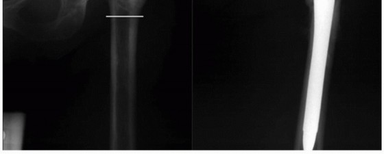 Illustration 22 for Extensively Porouscoated Stems: Proven Success & Superior Fixation