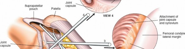 Illustration 8 for Mastering Knee Arthroscopy Approaches: Safely Withdraw the Arthroscope