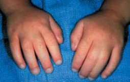 Syndactyly Release: Unlocking Digits of Differing Function