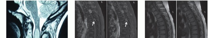 Relieving Pain: Surgical Excision of Intradural Extramedullary Tumors