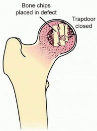 Illustration 10 for Head-Sparing for Osteonecrosis of the Femoral: Preserve Your Hip