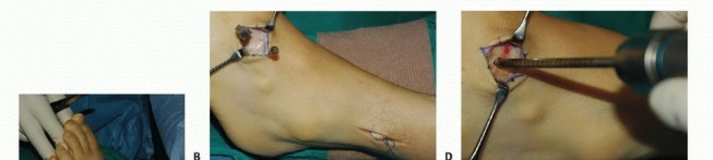 Illustration 13 for Foot Drop Surgery: How a Pin or Drill Elevates Tendon Transfer