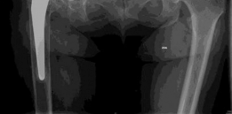 Illustration 2 for Revision Hip Success: Unpacking The Case Title Acetabular Grafting