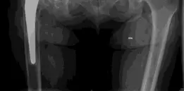 صورة توضيحية لـ جراحة مفصل الورك المراجع وزراعة العظم الحوضي: حلول متقدمة لآلام الورك المزمنة