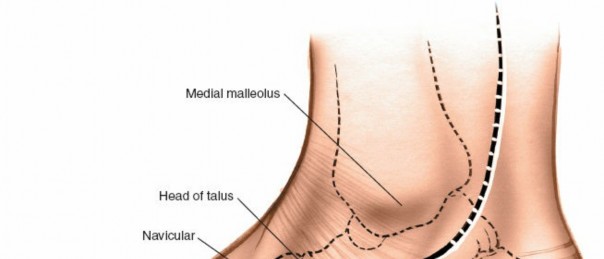 Dorsal Midfoot Approaches: Surgical Anatomy, Indications, & Techniques