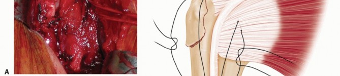 Illustration 14 for Optimizing Fixation of Proximal Humerus Fractures: A Guide