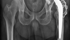 Illustration 2 for Revision THA: Unlocking Stability with Porous Tantalum Cups