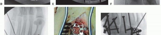 Illustration 24 for Fixation of Lisfranc Injuries: Essential Open Reduction Guide