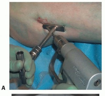 Illustration 25 for Is a Sliding Hip Screw Best for Your Femoral Neck Fracture?