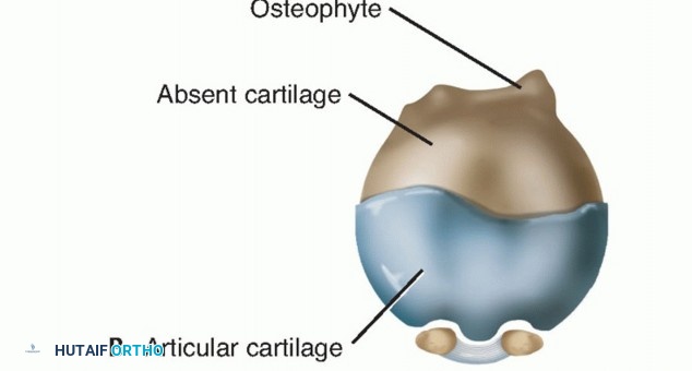 Illustration 2 for End Articular Cartilage Loss: Arthrosurface HemiCAP Resurfacing