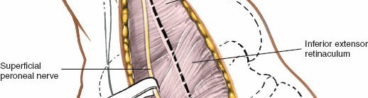 Illustration 89 for Optimized Approaches to the Dorsum of the Foot & Ankle