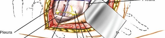 Illustration 326 for Approach to the Lumbar Spine: Mastering Techniques & Anatomy