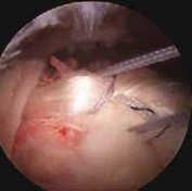 Illustration 12 for Resolve Long Head Biceps Pain: Advanced Arthroscopic Treatment