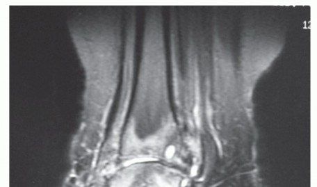 Illustration 11 for Unlock Stability: Medullary Nail Fixation for Tibiotalocalcaneal Arthrodesis