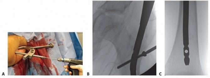 Illustration 23 for Pediatric Femoral Nailing: Targeting the Right aspect of the greater Trochanter