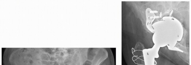 Illustration 14 for Sliding Trochanteric Osteotomy: Modern Role & Refined Techniques