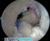 Illustration 11 for Successful Ligament Repair Revision: Fixing Failed ACLs