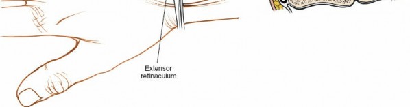 Illustration 25 for Dorsal Wrist Approach: Expert Access to the Column of the Distal Radius