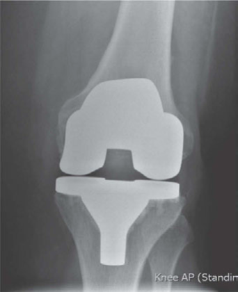 Illustration 2 for Structured Oral Examination: Infected TKA Case Questions